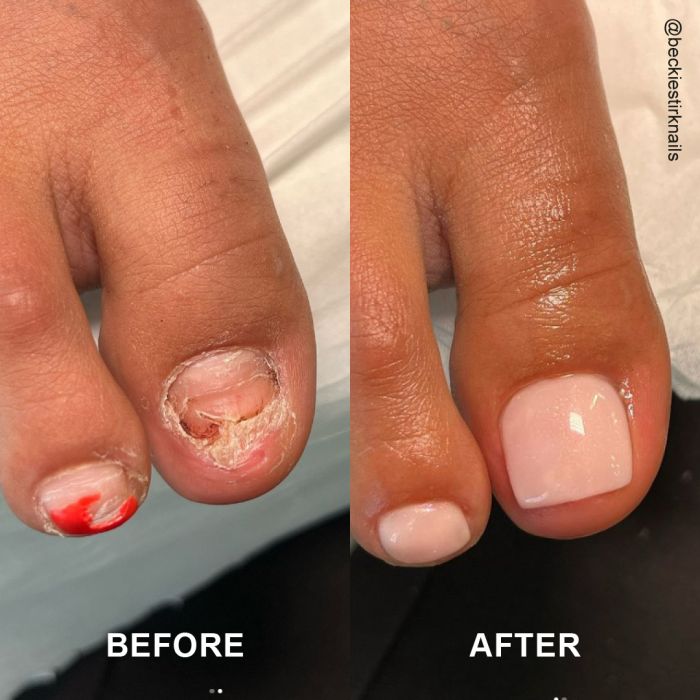 How does LCN work to repair and reconstruct toenails?